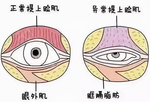 眼部提肌和上睑下垂有区别吗？眼部提肌可以改善上睑下垂