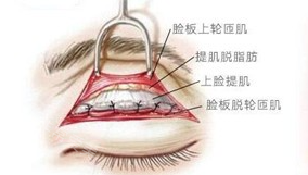 眼部提肌形象圖