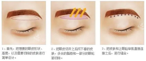 切眉手術(shù)圖