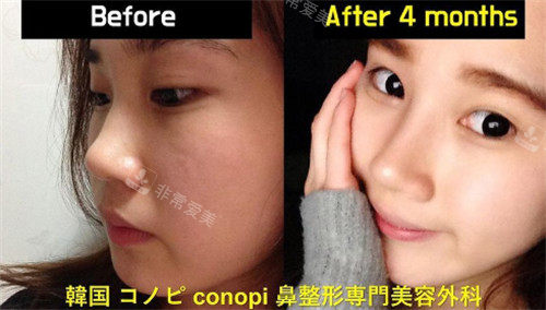 韩国高诺鼻整形鼻子手术照片