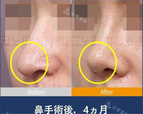 韩国高诺鼻整形鼻尖修复手术照片