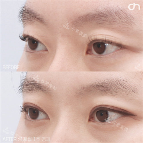 韓國喜可整形眼修復(fù)手術(shù)側(cè)面對比圖 韓國喜可整形眼修復(fù)手術(shù)側(cè)面對比圖