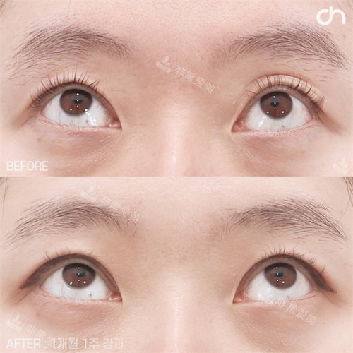 韓國喜可整形眼修復(fù)手術(shù)對比圖 韓國喜可整形眼修復(fù)手術(shù)對比圖