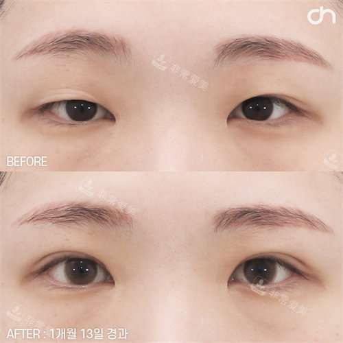 韩国喜可整形双眼皮手术正面对比图