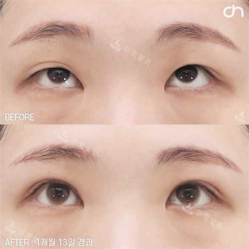 韩国喜可整形双眼皮手术对比图