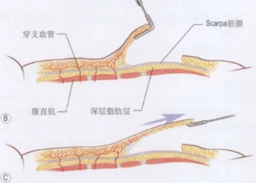 腹部皮膚結(jié)構(gòu)示意圖 腹部皮膚結(jié)構(gòu)示意圖