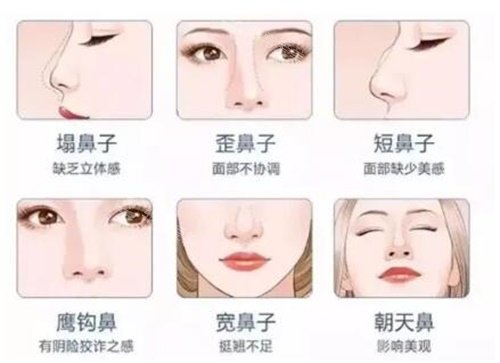 不同鼻型示意圖 不同鼻型示意圖