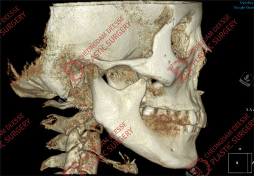 女神医院下颌角长曲线修复+大面积皮外板+下巴截骨缩小术前CT