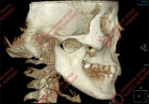 女神醫(yī)院下頜角長曲線修復(fù)+大面積皮外板+下巴截骨縮小術(shù)前CT