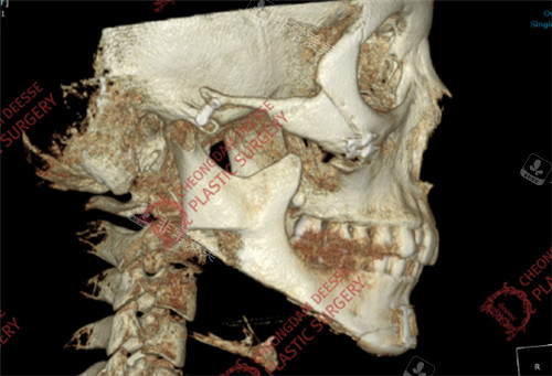 女神医院下颌角长曲线修复+大面积皮外板+下巴截骨缩小术后CT