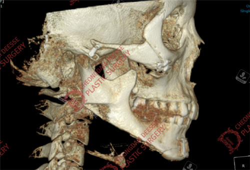 女神醫(yī)院下頜角長曲線修復(fù)+大面積皮外板+下巴截骨縮小術(shù)后CT