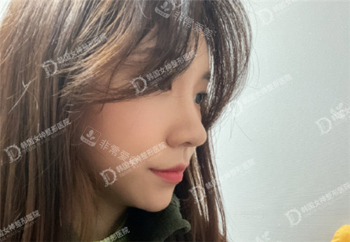 韩国女神整形异体肋骨鼻综合修复术后图
