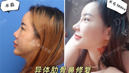 韩国女神整形韩国女神整形异体肋骨鼻综合修复术后图 异体肋骨修复挛缩鼻子对比照