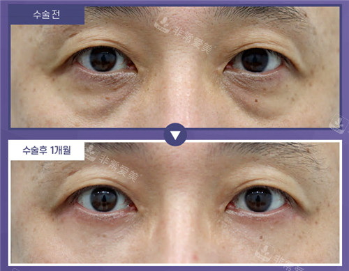 韩国Roi整形外科下眼睑手术对比照
