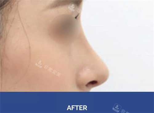 韩国Roi整形外科鼻部矫正术后图