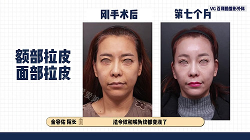 韓國(guó)VG百利酷整形外科拉皮對(duì)比照