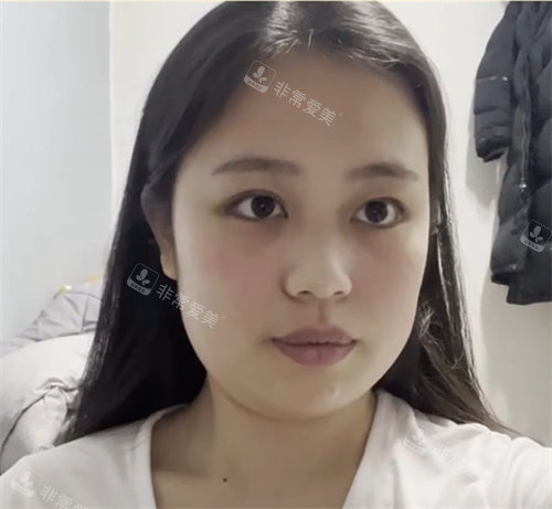 手术前照片 手术前照片