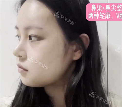 术后14天 术后14天