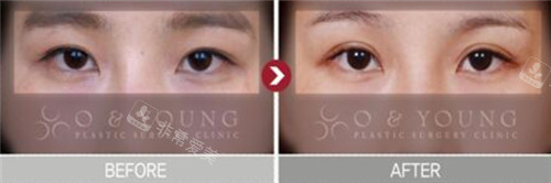 韩国格瑞丝噢爱美整形外科双眼皮手术对比照
