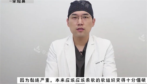 攣縮鼻會使鼻子變得僵硬 攣縮鼻會使鼻子變得僵硬