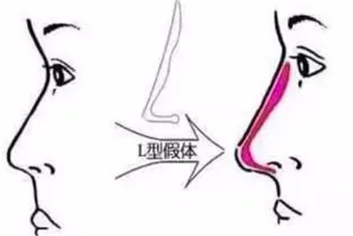 隆鼻假體圖 隆鼻假體圖