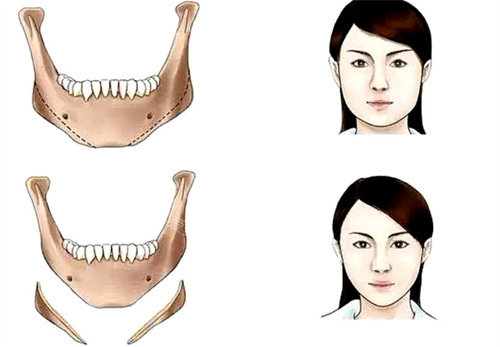 下頜角整形動(dòng)畫(huà)參考圖