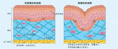 有皺紋和沒皺紋的對比圖 有皺紋和沒皺紋的對比圖