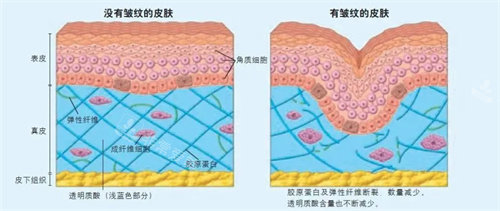 有皱纹和没皱纹的对比图