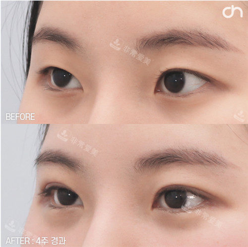 韩国喜可整形的眼部整形手术侧面图