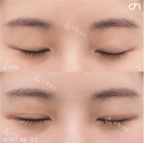韩国喜可整形的眼部整形手术照片疤痕照片