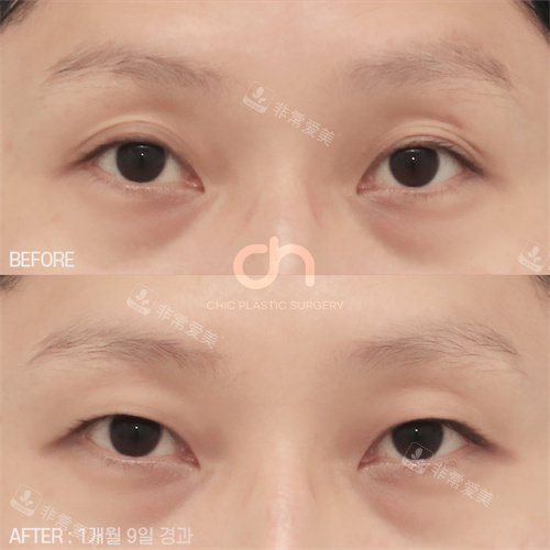  韩国喜可整形多层双眼皮变单眼皮手术正面对比图
