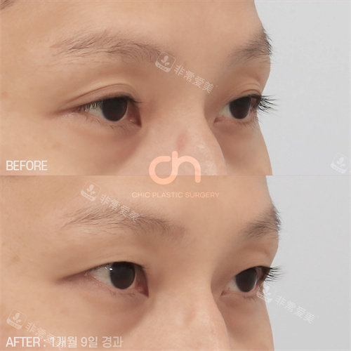  韩国喜可整形多层双眼皮变单眼皮手术对比图