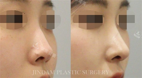 韩国真谈整形隆鼻手术对比图