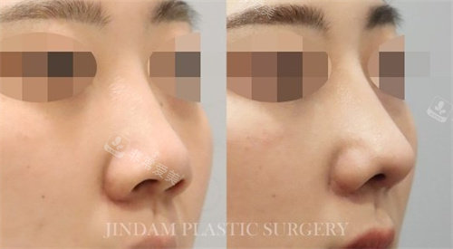 韩国真谈整形隆鼻手术对比图