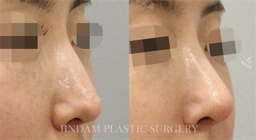 韩国真谈整形鼻修复手术对比图