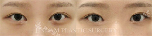 韩国真谈整形眼角修复手术对比图