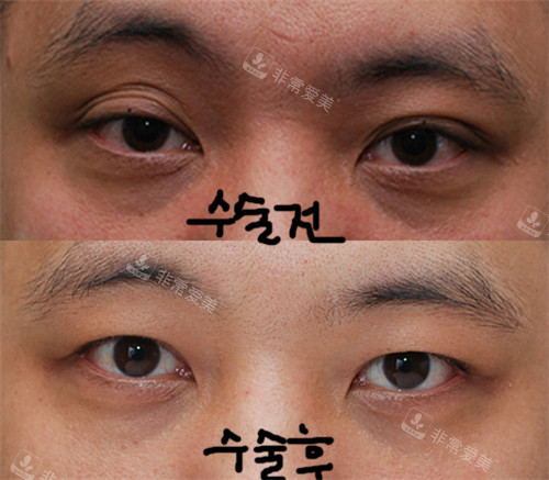 韩国来丽双眼皮改单实例:割过的双眼皮还能改单眼皮!