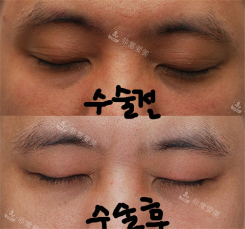 韩国来丽双眼皮改单眼皮疤痕情况