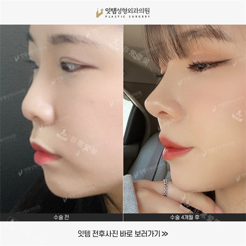 韩国ITTEM整形外科鼻整形对比照