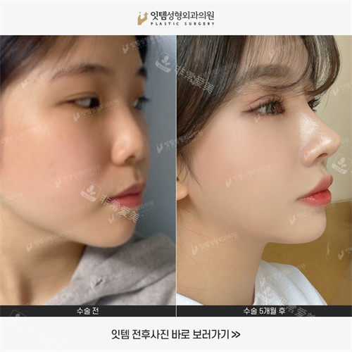 韩国ITTEM整形外科鼻子整形前后图