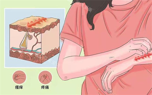 疤痕炎癥動畫圖 疤痕炎癥動畫圖