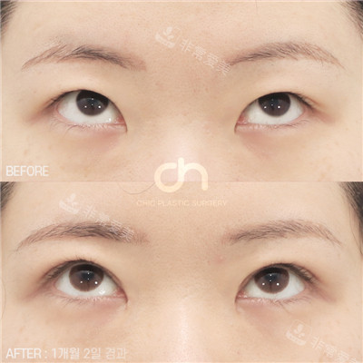 韩国喜可成形外科眼整形眼部整形对比图示