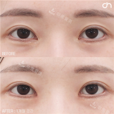 韓國喜可成形外科眼角修復對比 韓國喜可成形外科眼角修復對比