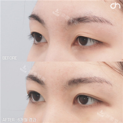 韓國喜可成形外科雙眼皮手術(shù)前后圖 韓國喜可成形外科雙眼皮手術(shù)前后圖