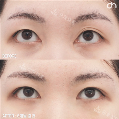 韩国喜可成形外科双眼皮手术眼部整形前后图
