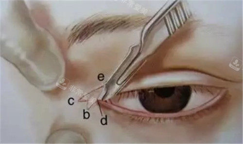 眼角手术的角度设计图