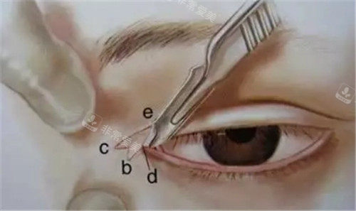 眼角手術(shù)的角度設(shè)計(jì)圖