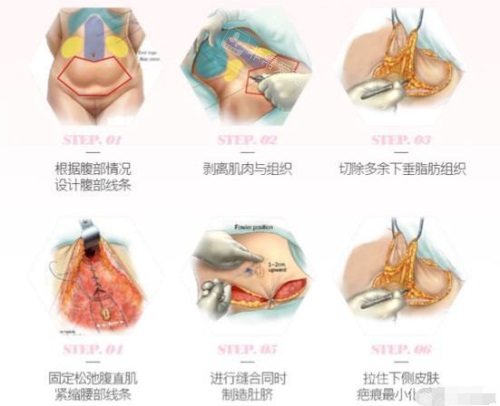 腹壁整形手术过程示意图