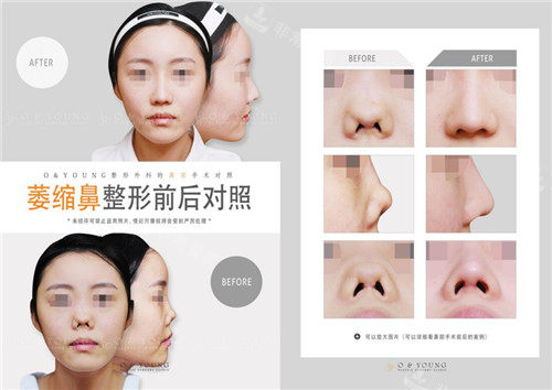 攣縮鼻修復前后圖片