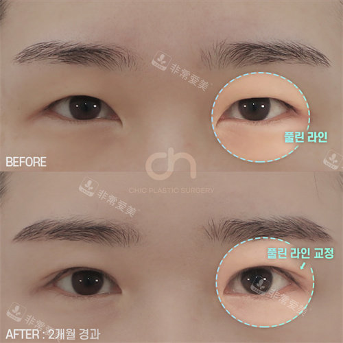 韩国喜可整形双眼皮+开内眼角手术对比图